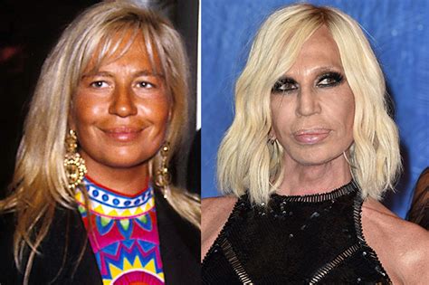 Le star prima e dopo la chirurgia: la trasformazione di Donatella 